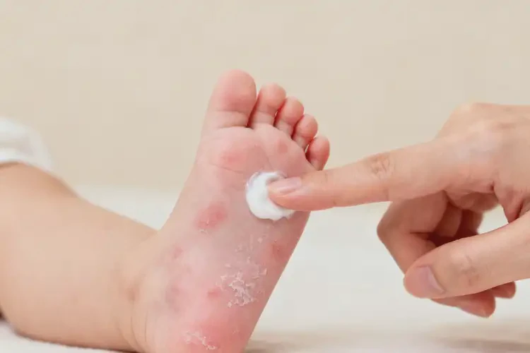 新生兒腳上容易長濕疹能夠徹底治愈嗎(圖1)