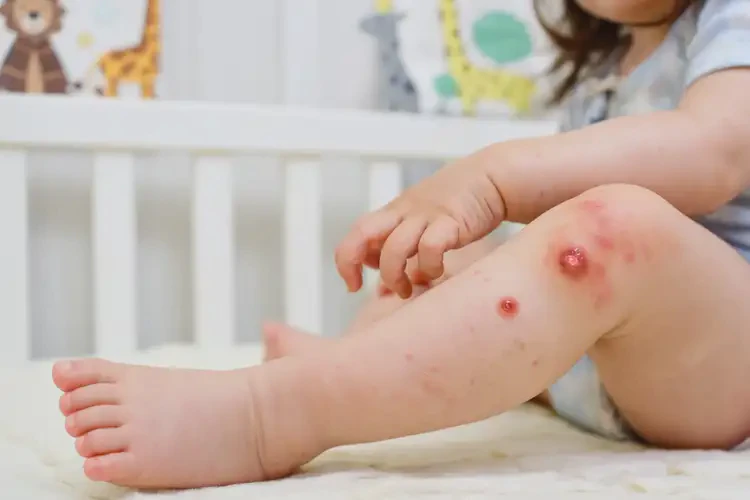 幼兒小腿偶爾起濕疹能徹底自愈嗎(圖4)