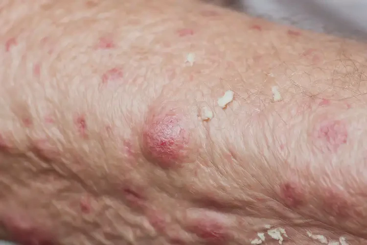 老人身上容易長濕疹不管它會自己自愈嗎(圖4)