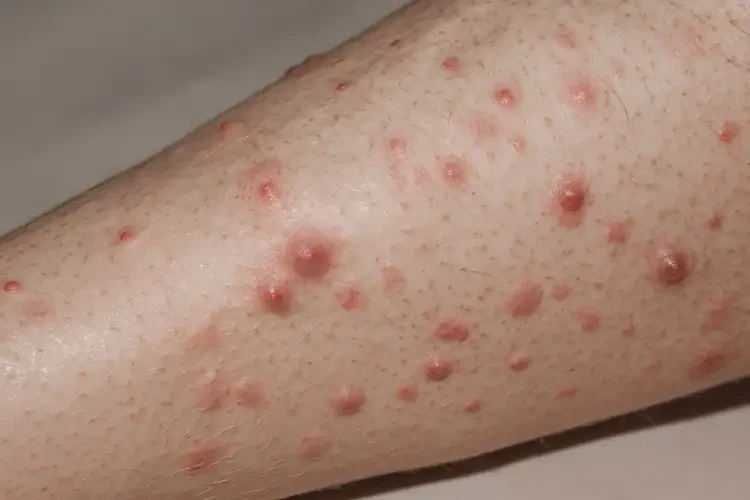 老年人小腿起濕疹可以徹底自愈嗎(圖4)