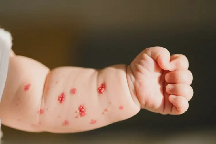 小兒全身容易起濕疹可不可以徹底自愈(圖2)