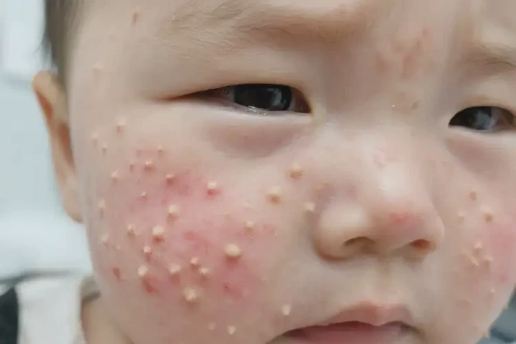 嬰幼兒臉上起濕疹不管它會(huì)自己好嗎(圖4)