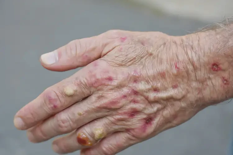 老人手上出濕疹不管它會自己自愈嗎(圖4)