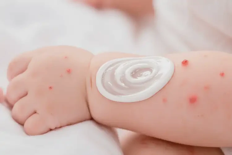 寶寶手臂起濕疹不管它會自己好嗎(圖2)