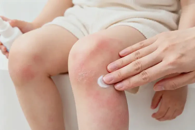 少兒大腿上出現(xiàn)濕疹可不可以徹底自愈(圖1)