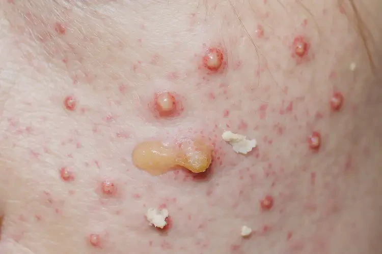 大学生脸上出湿疹不管它会自己好吗(图3)