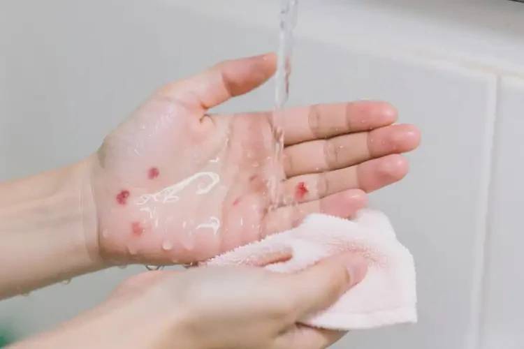 大學(xué)生手上經(jīng)常起濕疹不管它會自己好嗎(圖1)