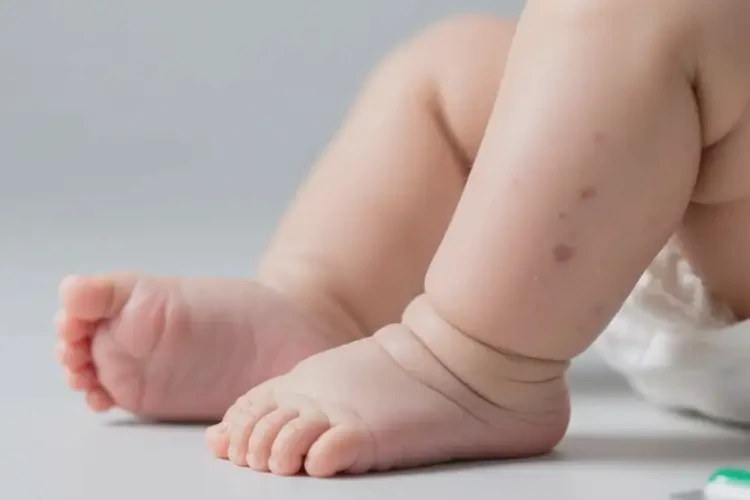 新生儿四肢有湿疹不管它会自己痊愈吗(图2)