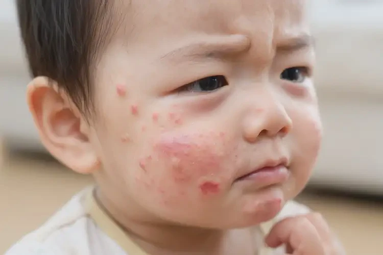 幼兒面部經(jīng)常起濕疹不管它會(huì)自己痊愈嗎(圖4)