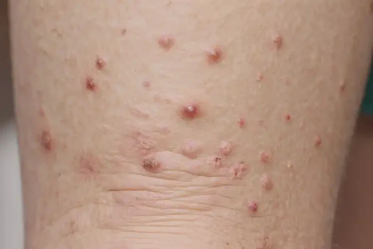 中學(xué)生小腿有濕疹能靠自己自愈嗎(圖4)
