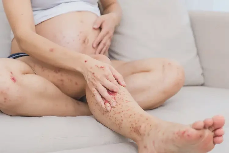孕婦腳上長濕疹不管它會自己痊愈嗎(圖4)