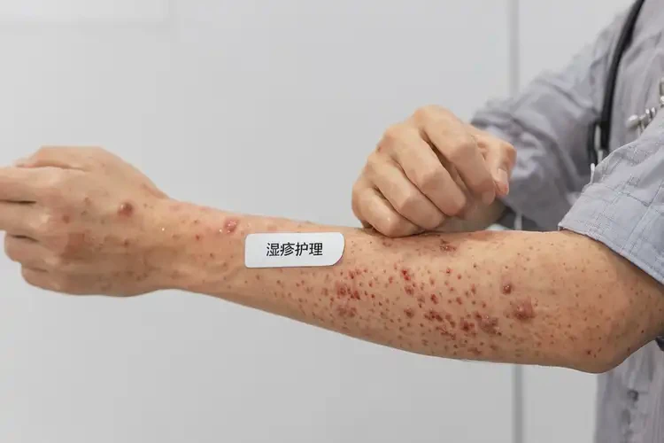 青年人手臂上容易起濕疹可以徹底自愈嗎(圖4)