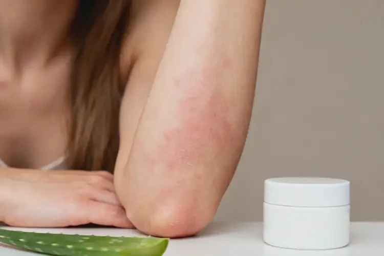 女性手臂出現(xiàn)濕疹可以徹底自愈嗎(圖1)