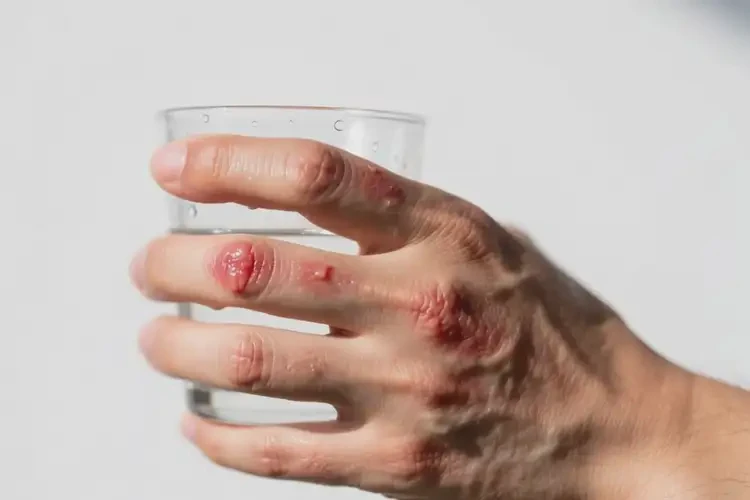 男人手上起濕疹可以徹底自愈嗎(圖1)