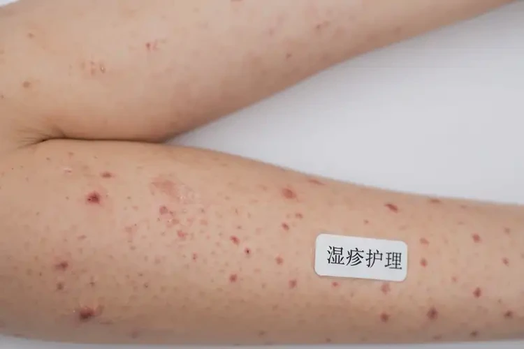 女性手臂上偶爾長(zhǎng)濕疹可以徹底自愈嗎(圖4)