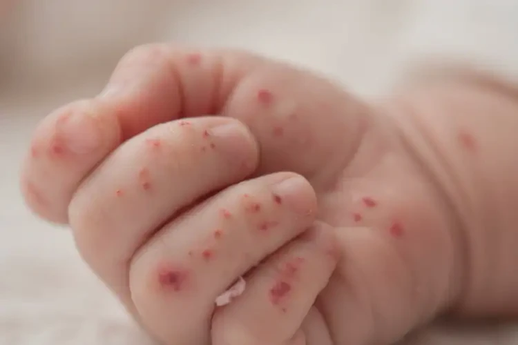 新生兒手上經(jīng)常起濕疹可以徹底自愈嗎(圖4)