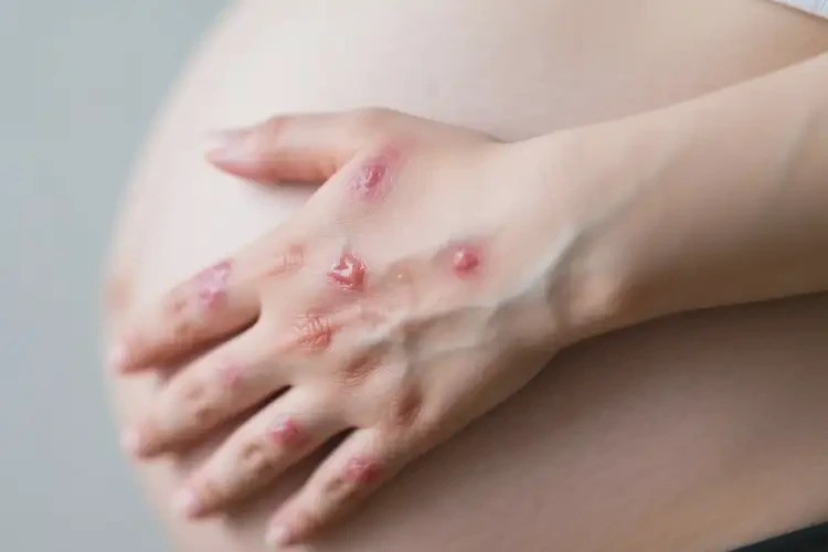 孕婦手上出濕疹不管它會自己自愈嗎(圖3)