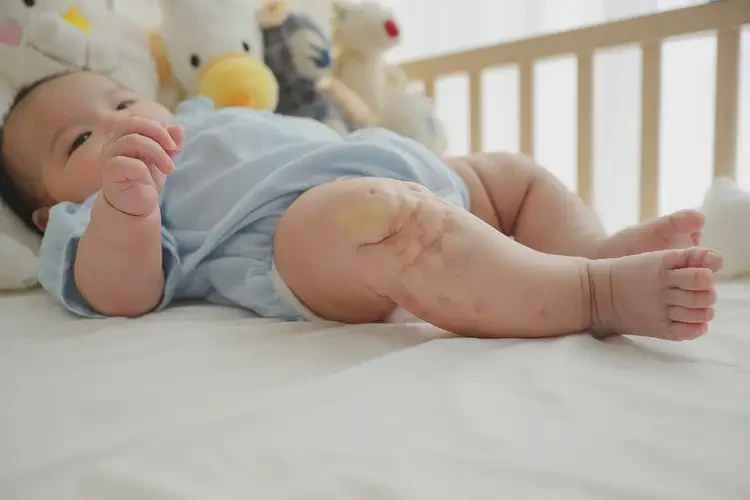 嬰幼兒大腿上長濕疹能夠徹底治愈嗎(圖1)