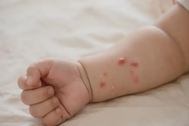 寶寶手臂出現(xiàn)濕疹能夠徹底治愈嗎(圖3)