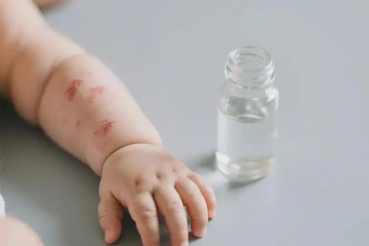 嬰幼兒手臂上偶爾長(zhǎng)濕疹能靠自己自愈嗎(圖2)