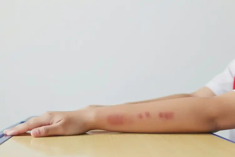 中學生手臂上出濕疹可不可以徹底自愈(圖3)