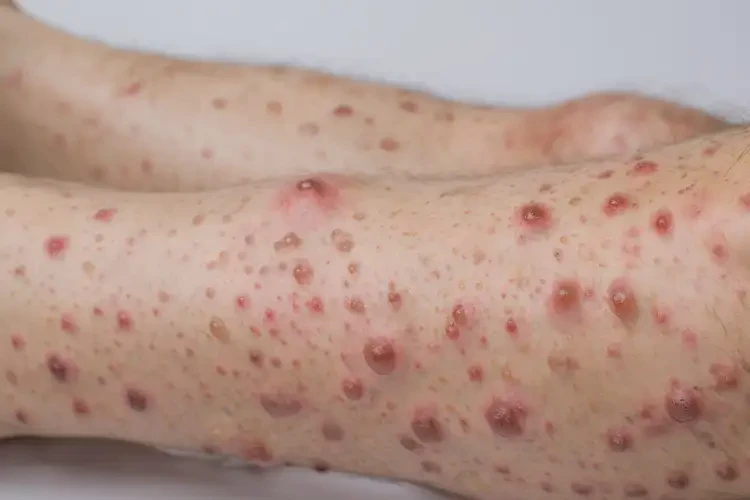 青年人四肢起濕疹不管它會(huì)自己自愈嗎(圖2)