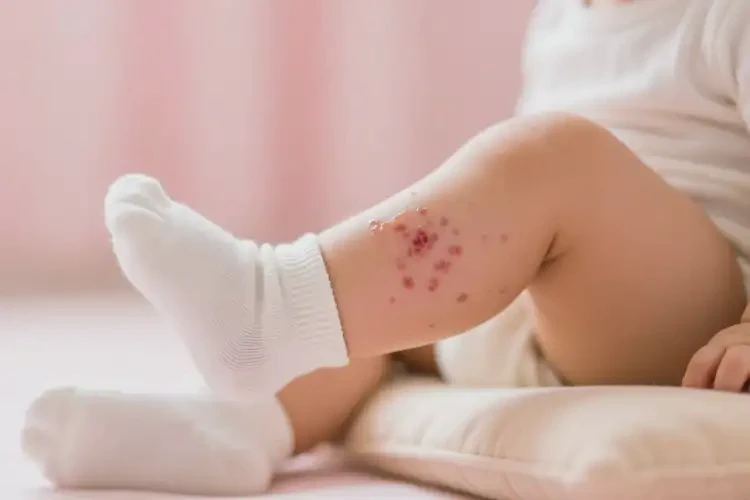 幼兒小腿出現(xiàn)濕疹不管它會(huì)自己好嗎(圖3)