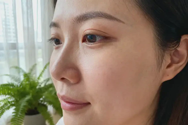 哺乳期妈妈面部容易长湿疹可不可以彻底自愈(图1)