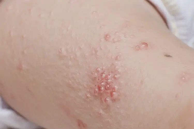 嬰兒大腿上長濕疹不管它會自己痊愈嗎(圖4)