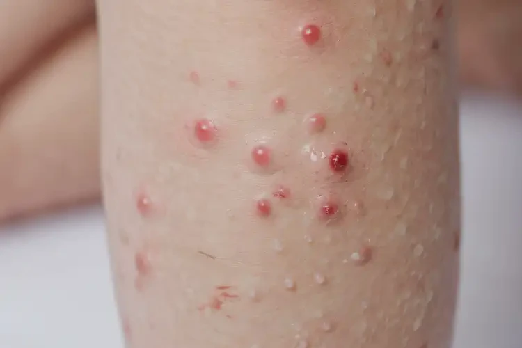 少兒小腿起濕疹能靠自己自愈嗎(圖4)