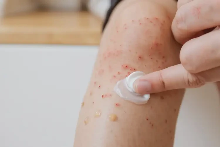 孩子小腿容易起濕疹不管它會(huì)自己自愈嗎(圖3)