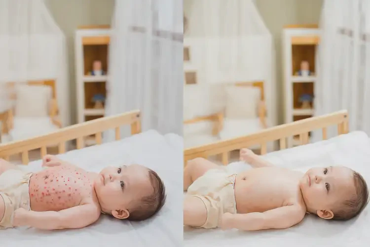 新生兒肚子偶爾長濕疹不管它會自己痊愈嗎(圖2)