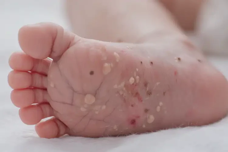 新生兒腳上長濕疹可以徹底自愈嗎(圖4)