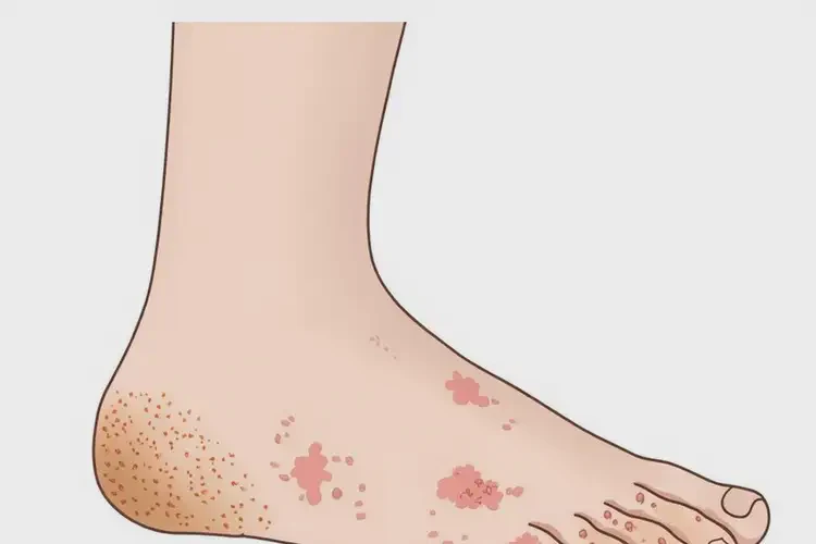 男生腳上經(jīng)常長(zhǎng)濕疹可以徹底自愈嗎(圖4)