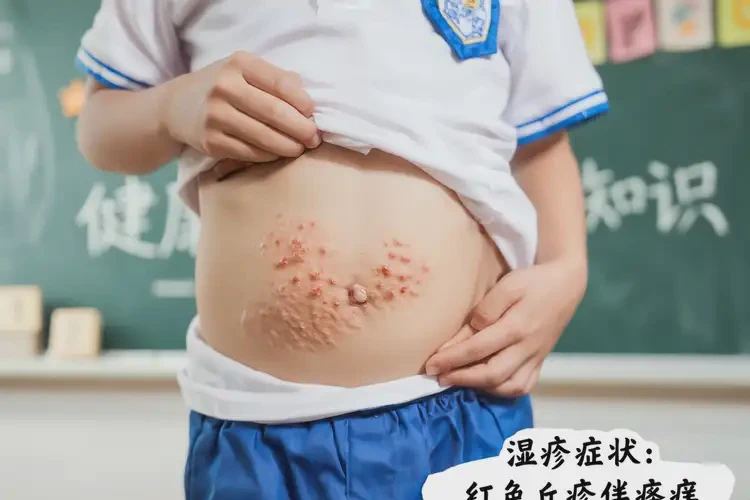 小學(xué)生肚子經(jīng)常長濕疹能不能徹底自愈(圖4)