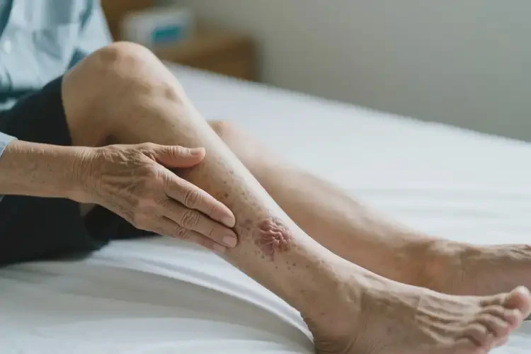 老人大腿有濕疹不管它會自己好嗎(圖3)