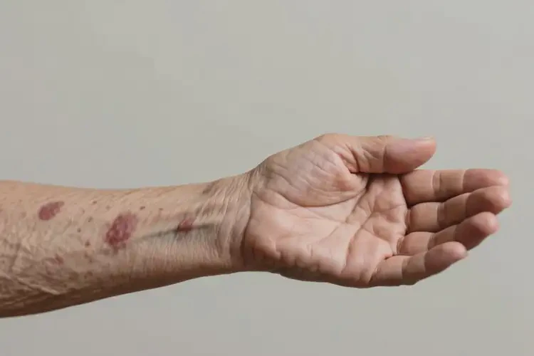 老人手臂長濕疹不管它會自己好嗎(圖1)