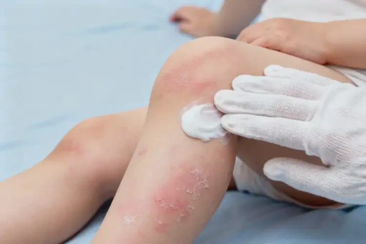 小孩大腿容易長濕疹可不可以徹底自愈(圖4)