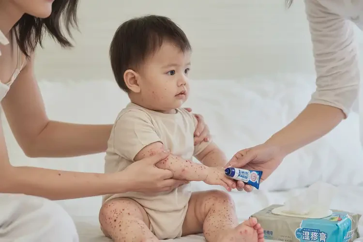 幼兒四肢起濕疹能靠自己自愈嗎(圖3)