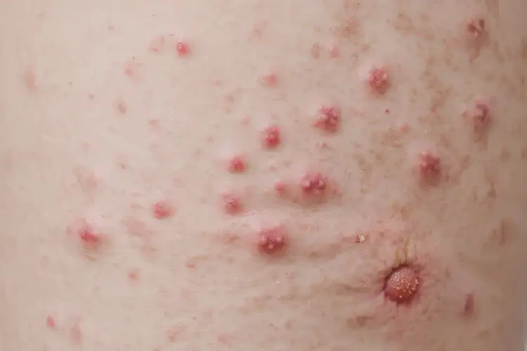 儿童大腿有湿疹可不可以彻底自愈(图4)