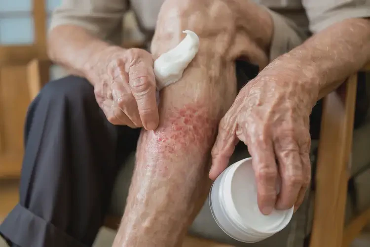 老年人小腿偶爾起濕疹能靠自己自愈嗎(圖4)