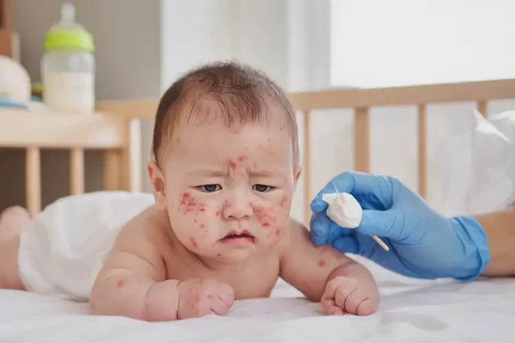 幼兒屁股經(jīng)常起濕疹不管它會(huì)自己好嗎(圖3)