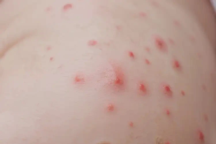 新生兒肛周經(jīng)常長濕疹能靠自己自愈嗎(圖4)