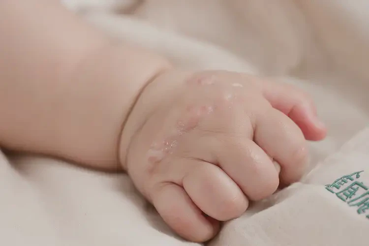 寶寶手上起濕疹不管它會(huì)自己自愈嗎(圖1)