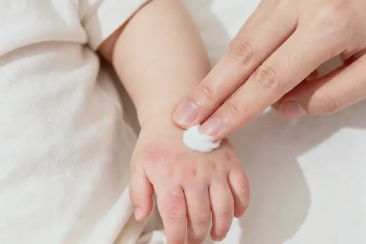 嬰兒手上出濕疹能靠自己自愈嗎(圖4)