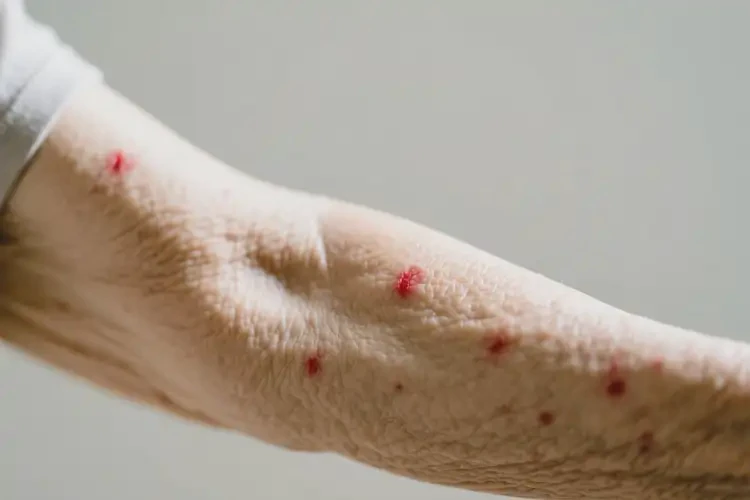 老年人手臂上偶爾長(zhǎng)濕疹不管它會(huì)自己自愈嗎(圖4)