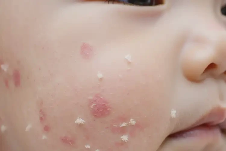 寶寶肛周容易起濕疹可不可以徹底自愈(圖4)