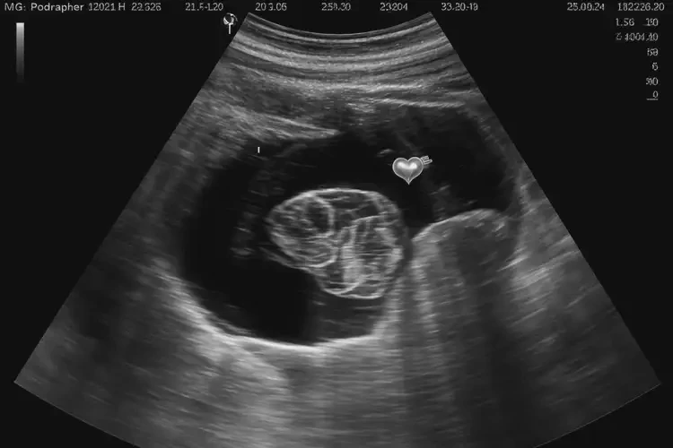 孕5周3天胎心183正常嗎(圖4)