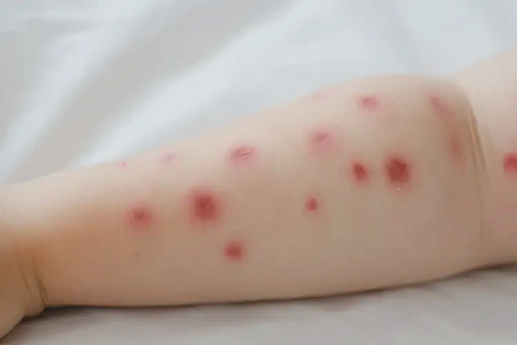 儿童屁股经常长湿疹不管它会自己自愈吗(图4)