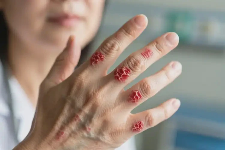 女人手上容易起湿疹不管它会自己好吗(图4)